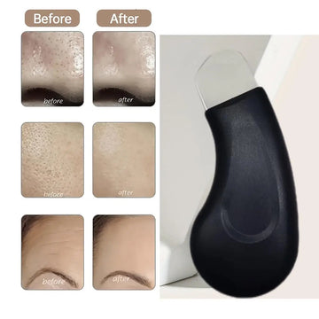 Manual acne extractor, capable of cleaning the skin of the nose and face, beauty care tool