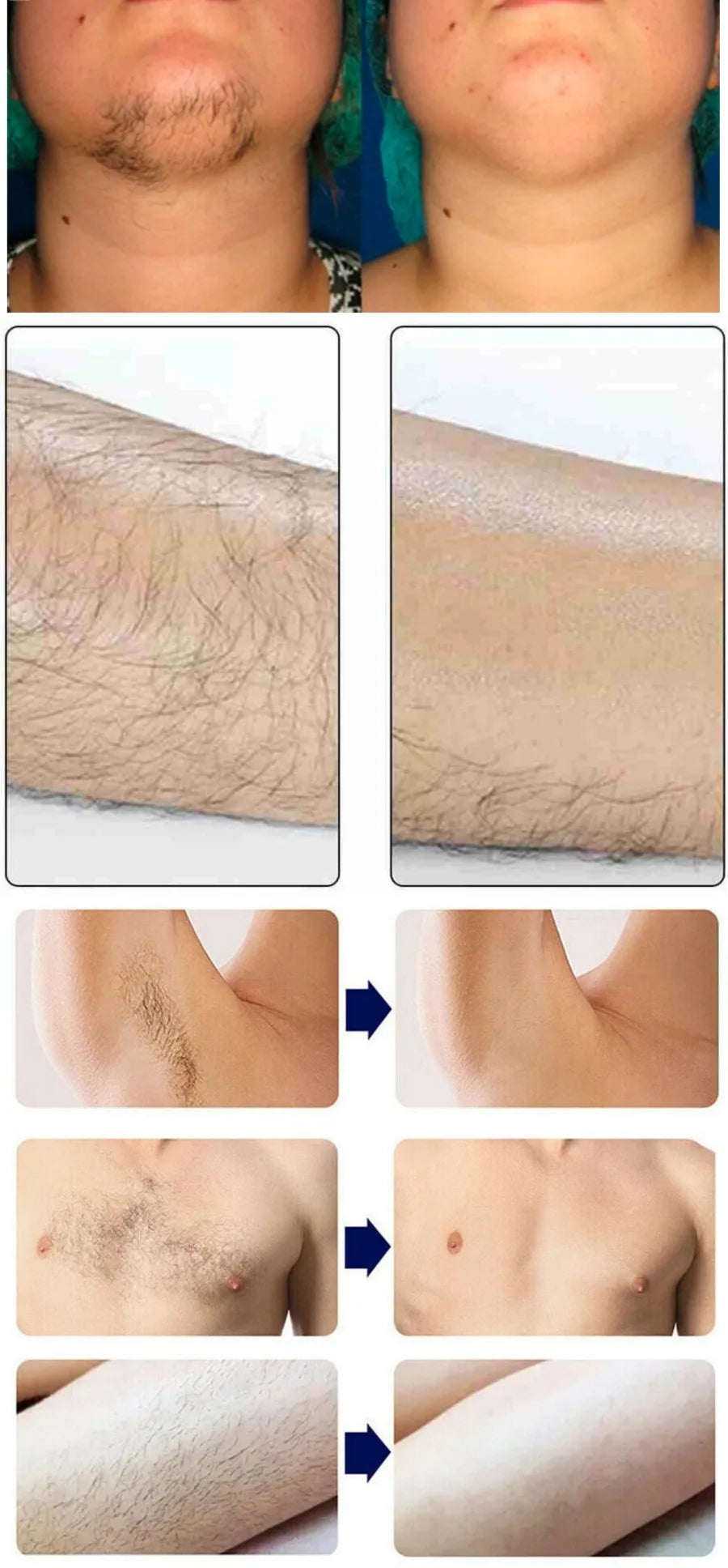 Professional Diode Ice Titanium Laser Hair Removal Machine Portable 808 755 1064 Alexandrite Device 3 Waves Permanent Removal