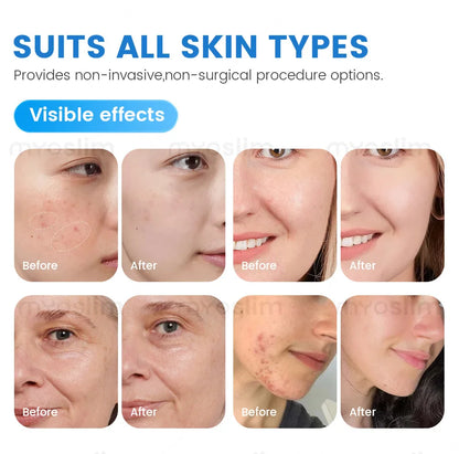 Intelligent Ice Blue Skin Management System – Hydro Facial Device For Wrinkle Reduction And Skin Care
