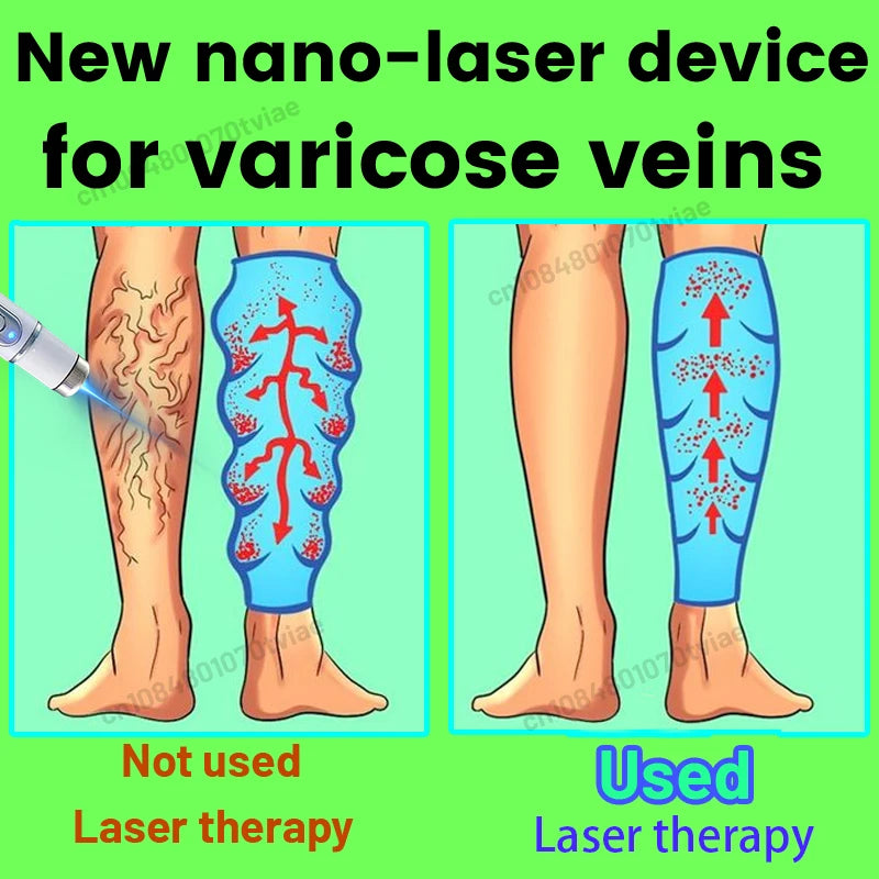 The days without varicose veins, the legs are very light
