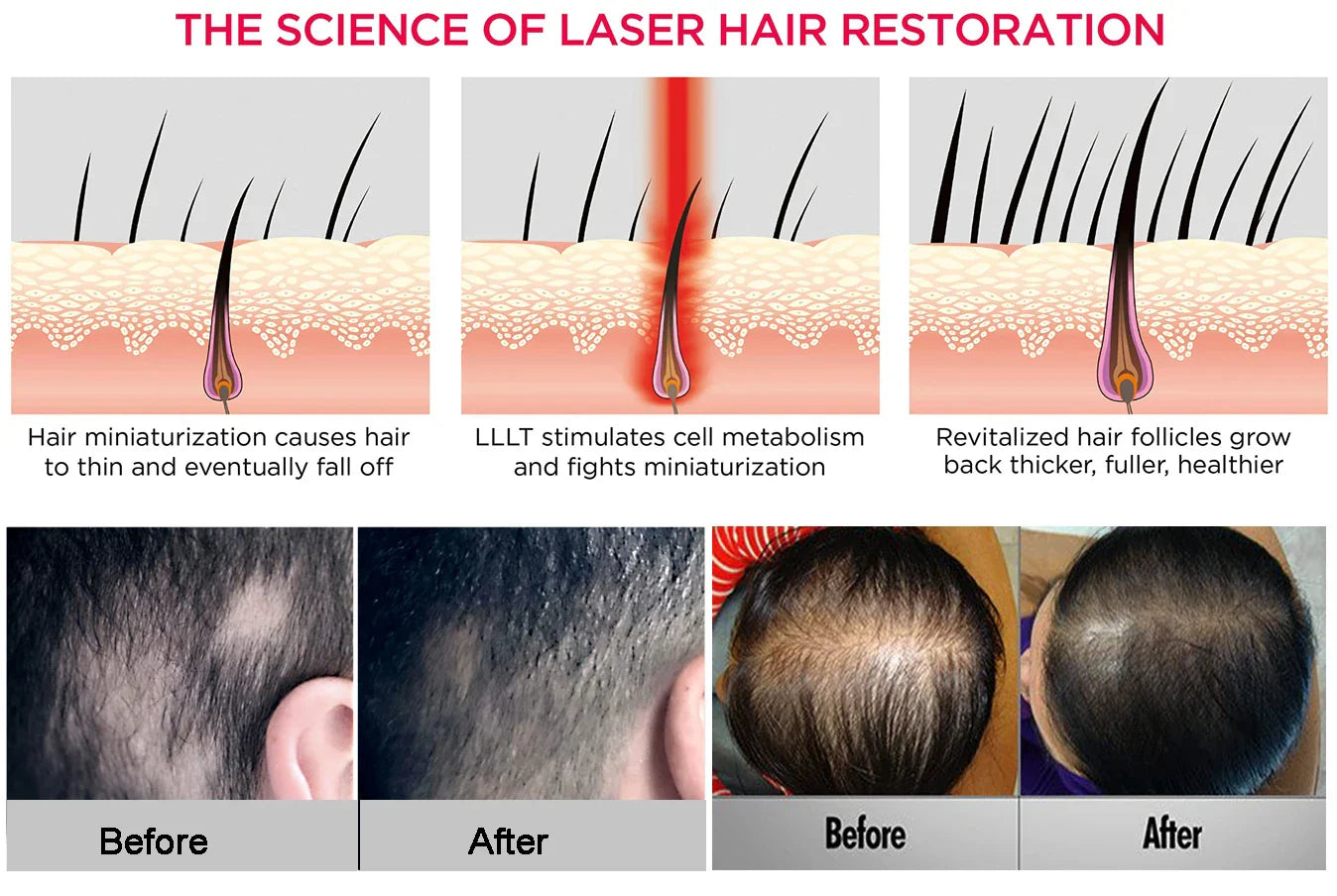 LLLT low leve laser 650nm hair loss products